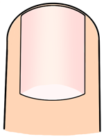 部分抜爪（手術）